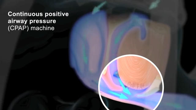 a graphic representation of the airway during sleep when a CPAP machine is in use. the graphic has text that reads Continuous positive airway pressure (CPAP) machine in the top left corner