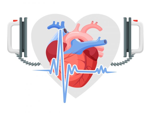What Is Cardiac Arrest?